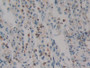 DAB staining on IHC-P; Samples: Human Lung cancer Tissue;  Primary Ab: 10µg/ml Rabbit Anti-Human HMG