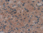 DAB staining on IHC-P; Samples: Human Glioma Tissue;  Primary Ab: 10µg/ml Rabbit Anti-Human IL29 Ant