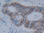 DAB staining on IHC-P; Samples: Human Rectum Cancer Tissue