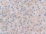 DAB staining on IHC-P; Samples: Human Liver cancer Tissue; Primary Ab: 10µg/ml Rabbit Anti-Human TLR3 Antibody Second Ab: 2µg/mL HRP-Linked Caprine Anti-Rabbit IgG Polyclonal Antibody