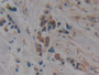 DAB staining on IHC-P; Samples: Human Breast cancer Tissue; Primary Ab: 10µg/ml Rabbit Anti-Human MAPt Antibody Second Ab: 2µg/mL HRP-Linked Caprine Anti-Rabbit IgG Polyclonal Antibody