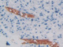 DAB staining on IHC-P; Samples: Human Glioma Tissue; Primary Ab: 10µg/ml Rabbit Anti-Human PEDF Antibody Second Ab: 2µg/mL HRP-Linked Caprine Anti-Rabbit IgG Polyclonal Antibody