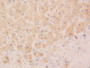 DAB staining on IHC-P; Samples: Human Liver Tissue;  Primary Ab: 20µg/ml Rabbit Anti-Human GSTa2 Ant
