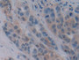 DAB staining on IHC-P; Samples: Human Breast cancer Tissue; Primary Ab: 10µg/ml Rabbit Anti-Human ChAT Antibody Second Ab: 2µg/mL HRP-Linked Caprine Anti-Rabbit IgG Polyclonal Antibody