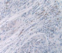 DAB staining on IHC-P; Samples:Human Rectum Cancer Tissue.