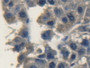 DAB staining on IHC-P; Samples: Human Liver cancer Tissue; Primary Ab: 20µg/ml Rabbit Anti-Human FGF10 Antibody Second Ab: 2µg/mL HRP-Linked Caprine Anti-Rabbit IgG Polyclonal Antibody