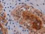 DAB staining on IHC-P; Samples: Human Breast Cancer Tissue; Primary Ab: 10µg/ml Rabbit Anti-Human EGFR2 Antibody Second Ab: 2µg/mL HRP-Linked Caprine Anti-Rabbit IgG Polyclonal Antibody