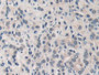 DAB staining on IHC-P; Samples: Human Prostate cancer Tissue; Primary Ab: 10µg/ml Rabbit Anti-Human MMP19 Antibody Second Ab: 2µg/mL HRP-Linked Caprine Anti-Rabbit IgG Polyclonal Antibody