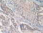 DAB staining on IHC-P; Samples: Human Lung Cancer Tissue.