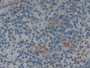 DAB staining on IHC-P; Samples: Human Skin Cancer Tissue.