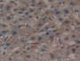 DAB staining on IHC-P; Samples: Human Liver cancer Tissue; Primary Ab: 10µg/ml Rabbit Anti-Human SHH Antibody Second Ab: 2µg/mL HRP-Linked Caprine Anti-Rabbit IgG Polyclonal Antibody