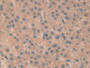 DAB staining on IHC-P; Samples: Human Liver cancer Tissue;  Primary Ab: 10µg/ml Rabbit Anti-Human RE