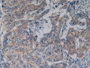 DAB staining on IHC-P; Samples: Human Breast Cancer Tissue.