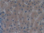 DAB staining on IHC-P; Samples: Human Liver Cancer Tissue.