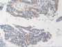 DAB staining on IHC-P; Samples: Human Rectum Cancer Tissue.