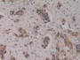 DAB staining on IHC-P; Samples: Human Breast Cancer Tissue