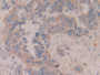 DAB staining on IHC-P; Samples: Human Breast cancer Tissue; Primary Ab: 10µg/ml Rabbit Anti-Human MAP2K6 Antibody Second Ab: 2µg/mL HRP-Linked Caprine Anti-Rabbit IgG Polyclonal Antibody