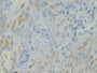 DAB staining on IHC-P; Samples: Human Skin cancer Tissue; Primary Ab: 10µg/ml Rabbit Anti-Human BCAM Antibody Second Ab: 2µg/mL HRP-Linked Caprine Anti-Rabbit IgG Polyclonal Antibody