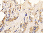 DAB staining on IHC-P; Samples: Human Breast cancer Tissue; Primary Ab: 10ug/ml Rabbit Anti-Human KRT10 Antibody Second Ab: 2µg/mL HRP-Linked Caprine Anti-Rabbit IgG Polyclonal Antibody