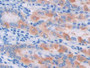 DAB staining on IHC-P; Samples: Human Stomach cancer Tissue)