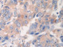 DAB staining on IHC-P; Samples: Human Breast cancer Tissue; Primary Ab: 10µg/ml Rabbit Anti-Human ETFb Antibody Second Ab: 2µg/mL HRP-Linked Caprine Anti-Rabbit IgG Polyclonal Antibody