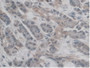 DAB staining on IHC-P; Samples: Human Pancreas Cancer Tissue.