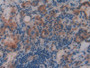 DAB staining on IHC-P; Samples: Human Thyroid Tissue; Primary Ab: 20µg/ml Rabbit Anti-Human NR3C1 Antibody Second Ab: 2µg/mL HRP-Linked Caprine Anti-Rabbit IgG Polyclonal Antibody