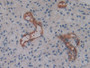 DAB staining on IHC-P; Samples: Human Glioma Tissue; Primary Ab: 10µg/ml Rabbit Anti-Human CYTH2 Antibody Second Ab: 2µg/mL HRP-Linked Caprine Anti-Rabbit IgG Polyclonal Antibody
