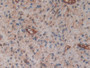 DAB staining on IHC-P; Samples: Human Glioma Tissue; Primary Ab: 10µg/ml Rabbit Anti-Human CYTH1 Antibody Second Ab: 2µg/mL HRP-Linked Caprine Anti-Rabbit IgG Polyclonal Antibody