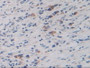 DAB staining on IHC-P; Samples: Human Stomach Cancer Tissue.