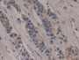DAB staining on IHC-P; Samples: Human Breast cancer Tissue;  Primary Ab: 10µg/ml Rabbit Anti-Human P