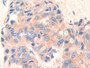 DAB staining on IHC-P; Samples: Human Breast Cancer Tissue.