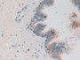 DAB staining on IHC-P; Samples: Human Prostate Tissue; Primary Ab: 10µg/ml Rabbit Anti-Human PRSS2 Antibody Second Ab: 2µg/mL HRP-Linked Caprine Anti-Rabbit IgG Polyclonal Antibody