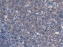 DAB staining on IHC-P; Samples: Human Endometrial cancer Tissue; Primary Ab: 20µg/ml Rabbit Anti-Human CSF2Rb Antibody Second Ab: 2µg/mL HRP-Linked Caprine Anti-Rabbit IgG Polyclonal Antibody