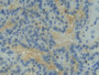 DAB staining on IHC-P; Samples: Human Thyroid cancer Tissue; Primary Ab: 20µg/ml Rabbit Anti-Human TNFRSF9 Antibody Second Ab: 2µg/mL HRP-Linked Caprine Anti-Rabbit IgG Polyclonal Antibody