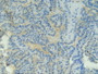 DAB staining on IHC-P; Samples: Human Thyroid Cancer Tissue.