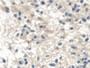 DAB staining on IHC-P; Samples: Human Glioma Tissue; Primary Ab: 20µg/ml Rabbit Anti-Human NAIP Antibody Second Ab: 2µg/mL HRP-Linked Caprine Anti-Rabbit IgG Polyclonal Antibody