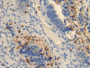 DAB staining on IHC-P; Samples: Human Colorectal cancer Tissue)