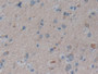 DAB staining on IHC-P; Samples: Human Glioma Tissue; Primary Ab: 10µg/ml Rabbit Anti-Human IFNgR1 Antibody Second Ab: 2µg/mL HRP-Linked Caprine Anti-Rabbit IgG Polyclonal Antibody