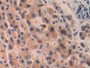 DAB staining on IHC-P; Samples: Human Liver cancer Tissue; Primary Ab: 25µg/ml Rabbit Anti-Human MP1 Antibody Second Ab: 2µg/mL HRP-Linked Caprine Anti-Rabbit IgG Polyclonal Antibody