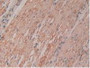 DAB staining on IHC-P; Samples: Human Rectum Cancer Tissue.