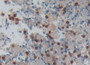 DAB staining on IHC-P; Samples: Human Lung cancer Tissue; Primary Ab: 20µg/ml Rabbit Anti-Human PP13 Antibody Second Ab: 2µg/mL HRP-Linked Caprine Anti-Rabbit IgG Polyclonal Antibody