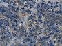 DAB staining on IHC-P; Samples: Human Thyroid cancer Tissue; Primary Ab: 20µg/ml Rabbit Anti-Human TH Antibody Second Ab: 2µg/mL HRP-Linked Caprine Anti-Rabbit IgG Polyclonal Antibody