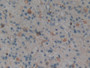 DAB staining on IHC-P; Samples: Human Glioma Tissue.