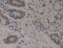 DAB staining on IHC-P; Samples: Human Stomach cancer Tissue; Primary Ab: 10µg/ml Rabbit Anti-Human MSE Antibody Second Ab: 2µg/mL HRP-Linked Caprine Anti-Rabbit IgG Polyclonal Antibody