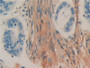 DAB staining on IHC-P; Samples: Human Colorectal cancer Tissue; Primary Ab: 10µg/ml Rabbit Anti-Human Thy1 Antibody Second Ab: 2µg/mL HRP-Linked Caprine Anti-Rabbit IgG Polyclonal Antibody