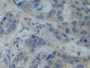 DAB staining on IHC-P; Samples: Human Breast cancer Tissue;  Primary Ab: 10µg/ml Rabbit Anti-Human S