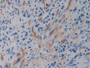 DAB staining on IHC-P; Samples: Human Prostate cancer Tissue; Primary Ab: 10µg/ml Rabbit Anti-Human VEGFR2 Antibody Second Ab: 2µg/mL HRP-Linked Caprine Anti-Rabbit IgG Polyclonal Antibody