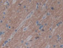 DAB staining on fromalin fixed paraffin- embedded prostate gland cancer tissue)