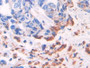 DAB staining on IHC-P; Samples: Human Breast cancer Tissue; Primary Ab: 30µg/ml Rabbit Anti-Human ADRP Antibody Second Ab: 2µg/mL HRP-Linked Caprine Anti-Rabbit IgG Polyclonal Antibody